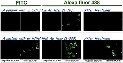 Optimization of an Anti-NMDA Receptor Autoantibody Diagnostic Bioassay